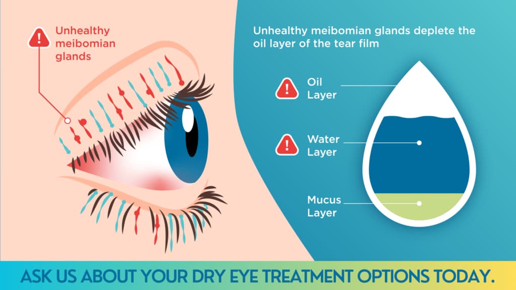 dry-eye-treatment-options-today dry-eye-treatment-options-today